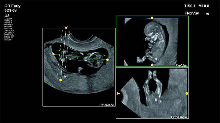 FlexVue and Orthogonal view clinical applications youtube video thumbnail