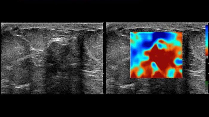 q-app elastography analysis thumbnail