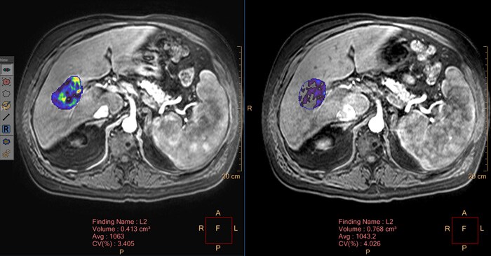 Liver lesion imaging