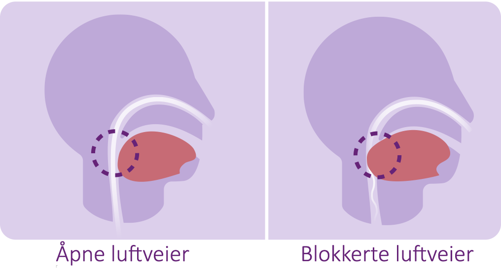 søvnapnédiagram