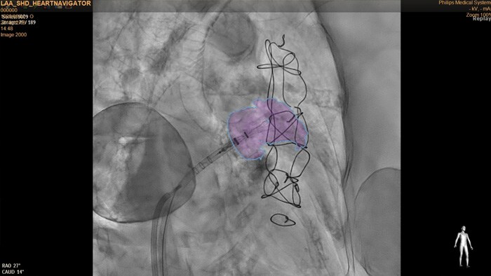HeartNavigator CT planning