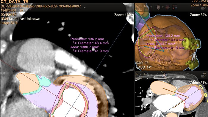 HeartNavigator heart model