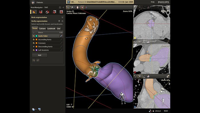 HeartNavigator heart model