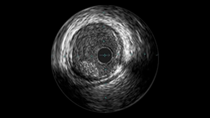 Saphenous vein graft and thrombus lesions