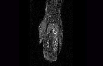 Hand/Wrist with tumor