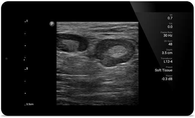 Get the clarity of larger ultrasound systems with Lumify