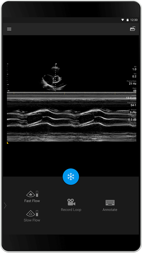 Echo Exam (Ekkoundersøkelse), S4-1